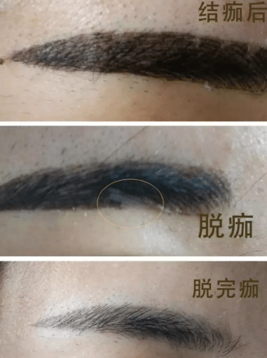 紋眉后結(jié)痂脫落