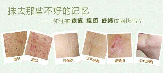 激光祛疤效果如何？術(shù)后有什么需要注意的？