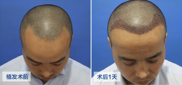 種植頭發(fā)要多少錢(qián)? 種植頭發(fā)要多少錢(qián)?