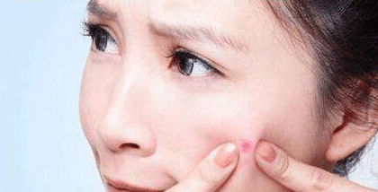 怎么才能改變油痘肌擁有好皮膚？果酸換膚有用嗎？