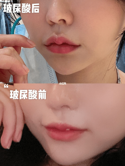 玻尿酸豐唇的效果怎么樣? 玻尿酸豐唇的效果怎么樣?