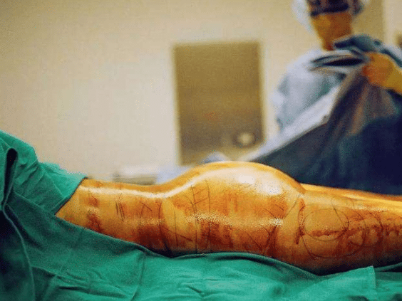 吸脂手術(shù) 吸脂手術(shù)