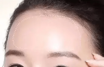 膨體豐額頭手術(shù)效果怎么樣？術(shù)后會(huì)不會(huì)出現(xiàn)腫脹？