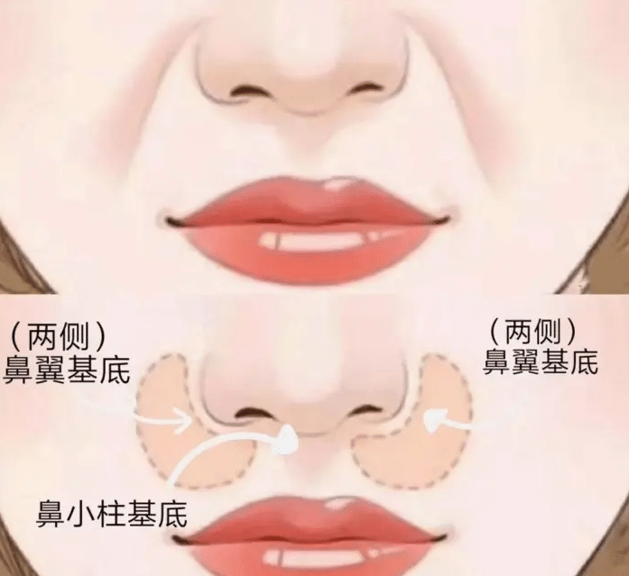 鼻基底自測方法及填充方法！注射填充、手術(shù)填充