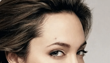 激光洗眉前后需要注意什么？出血了該怎么辦？