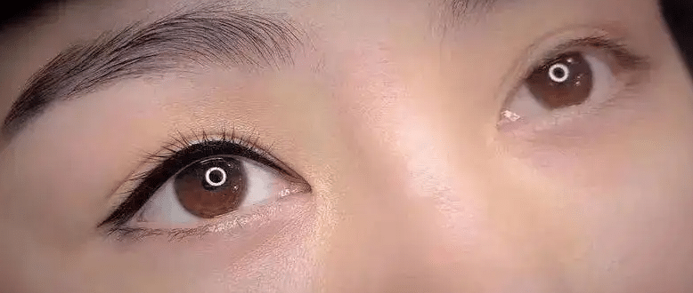 美瞳線結痂是否可以摳?已經(jīng)被摳了要怎么辦？|注意事項