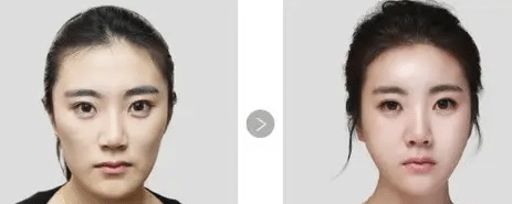 面部脂肪填充前后對(duì)比 面部脂肪填充前后對(duì)比