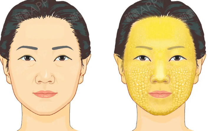 面部脂肪填充 面部脂肪填充