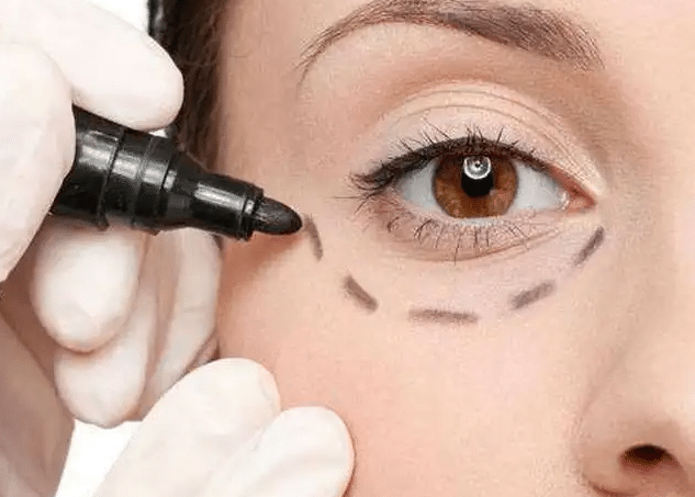 超聲波去眼袋 超聲波去眼袋