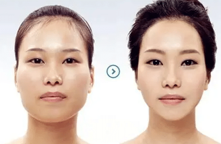 發(fā)際線種植 發(fā)際線種植