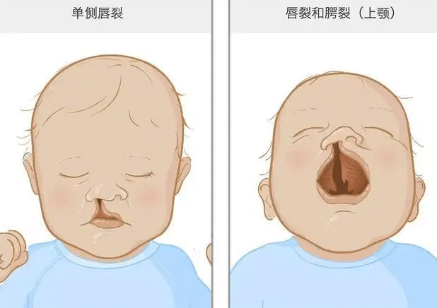 唇裂術(shù)后畸形修復(fù)的效果如何？出現(xiàn)疤痕該怎么辦？