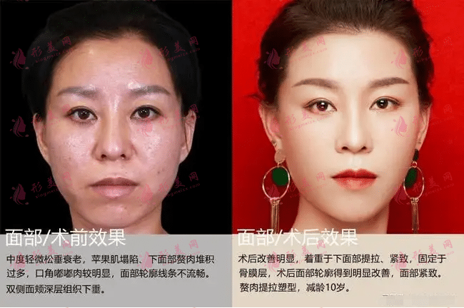 面部除皺適合哪些人?