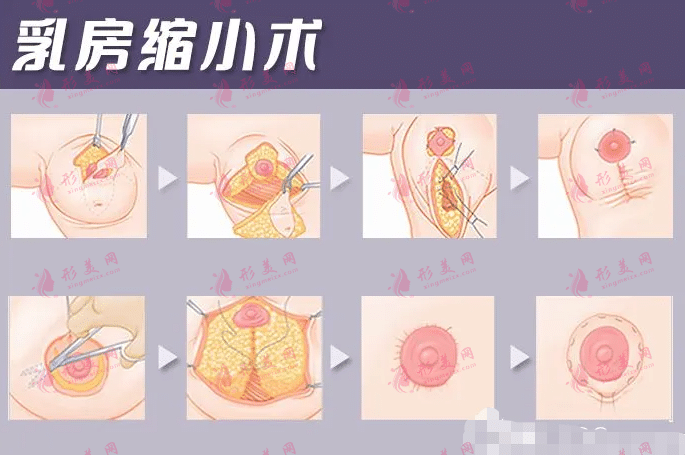幾歲可以做乳房縮小手術(shù)?