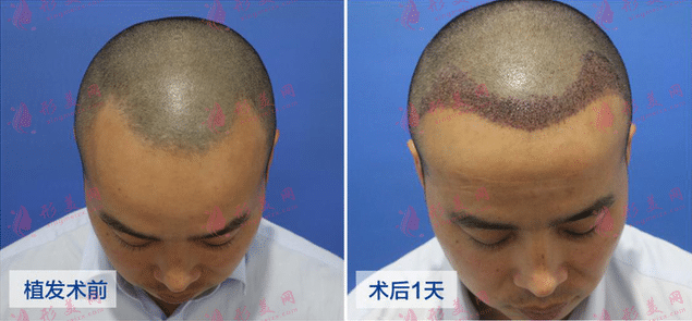 西安碧蓮盛植發(fā)醫(yī)院 西安碧蓮盛植發(fā)醫(yī)院