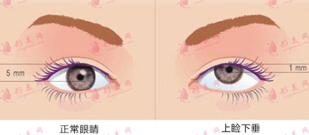 上瞼下垂 上瞼下垂