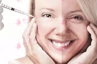 年輕女性適合的整容項目|注射除皺、微電波拉皮