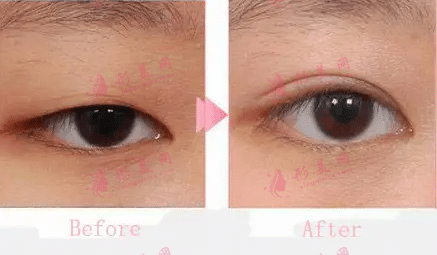 埋線雙眼皮大概需要多少錢? 埋線雙眼皮大概需要多少錢?