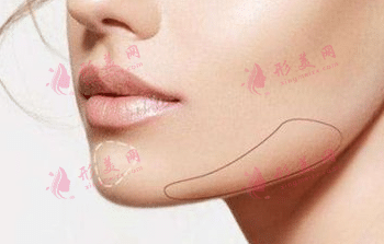 玻尿酸墊下巴 玻尿酸墊下巴