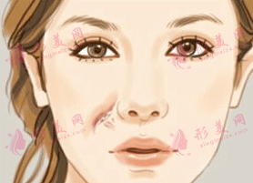 激光祛疤的優(yōu)勢(shì)|激光祛疤能維持多長(zhǎng)時(shí)間？