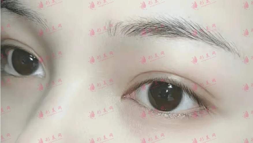 雙眼皮手術(shù)后恢復(fù)自然需要多長(zhǎng)時(shí)間? 雙眼皮手術(shù)后恢復(fù)自然需要多長(zhǎng)時(shí)間?