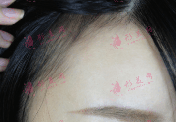 發(fā)際線種植后長(zhǎng)出來(lái)的頭發(fā)還會(huì)再掉嗎?