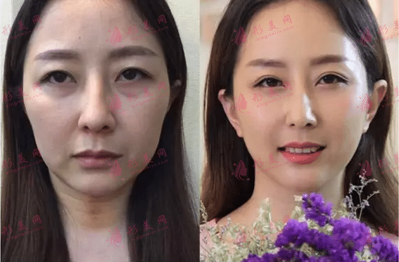 北京面部拉皮除皺案例 北京面部拉皮除皺案例