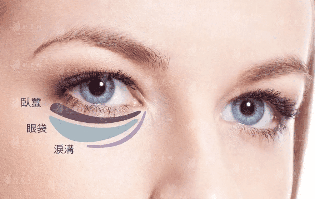 不開刀去眼袋能保持多久? 不開刀去眼袋能保持多久?