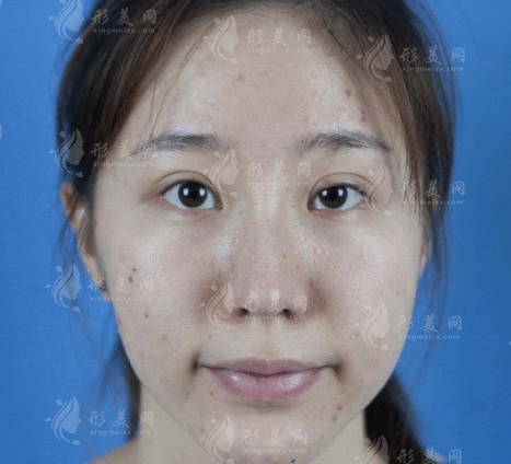 武漢五洲整形美容醫(yī)院面部提升價(jià)格貴嗎？收費(fèi)表及案例公布