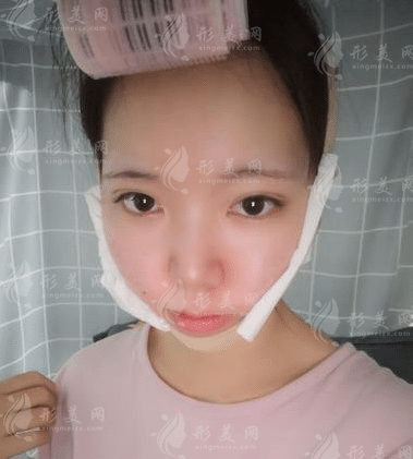 上海九院韋敏磨骨怎么樣？顴骨下頜角價(jià)格表|手術(shù)案例鑒賞