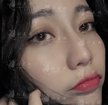 上海九院祝聯(lián)隆鼻多少錢？全新收費標(biāo)準(zhǔn)及案例一覽