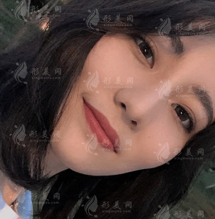 上海九院祝聯(lián)隆鼻多少錢？全新收費標(biāo)準(zhǔn)及案例一覽