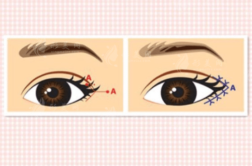 開外眼角會(huì)不會(huì)有疤痕？這些“毀眼習(xí)慣”你中招了嗎？