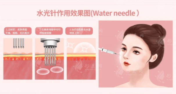 長效水光針真的長效嗎？長效水光針的種類有哪些？