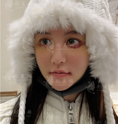 杭州李保鍇修復(fù)鼻子怎么樣？醫(yī)生簡(jiǎn)介+鼻修復(fù)案例鑒賞