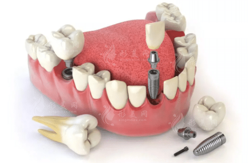 牙齒種植