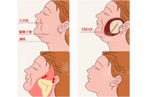 北京聯(lián)合麗格楊大平哪項(xiàng)手術(shù)更專業(yè)?