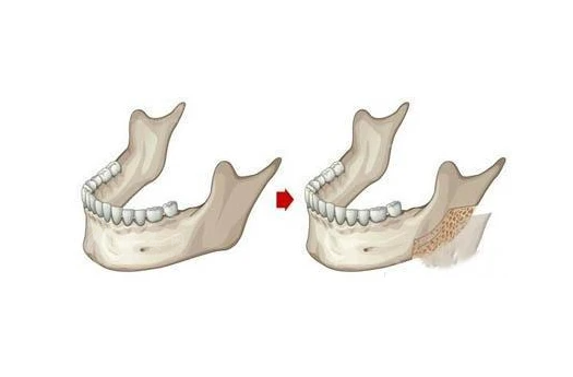 王勇院長(zhǎng)磨骨技術(shù)優(yōu)勢(shì)