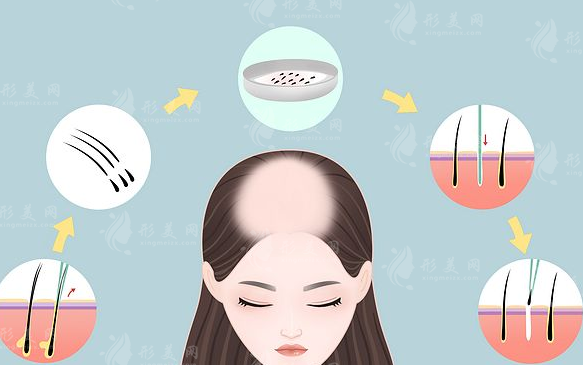 四川省人民醫(yī)院可以植發(fā)嗎？醫(yī)生介紹+案例分享+價格表