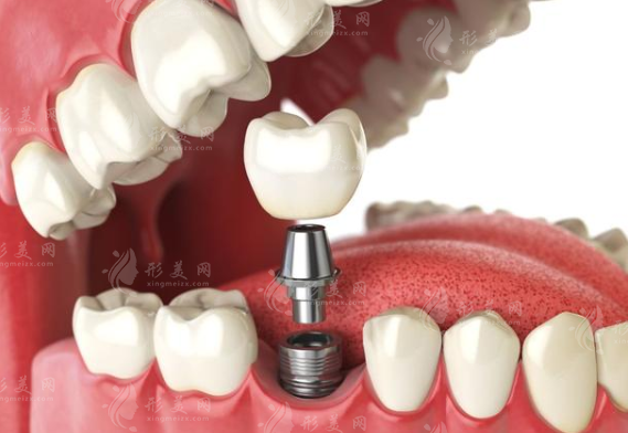 種植牙
