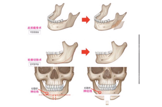 下頜角截骨手術
