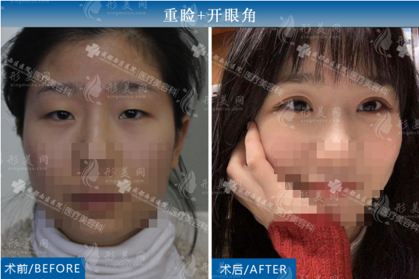 成都西區(qū)楊世界醫(yī)生案例展示