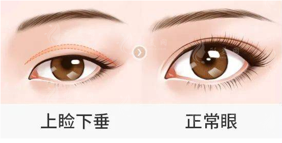 眼瞼下垂矯正方法是什么？上瞼提升術(shù)、眼輪匝肌重建術(shù)...