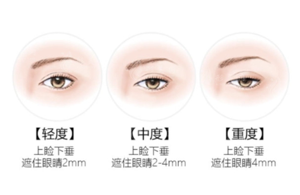 眼瞼下垂矯正方法是什么？上瞼提升術(shù)、眼輪匝肌重建術(shù)...