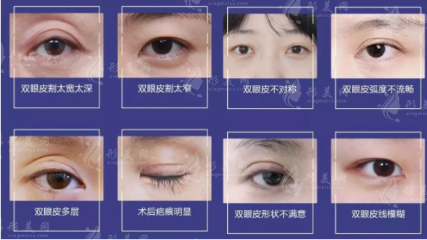 雙眼皮手術(shù)類型有哪些？割雙眼皮術(shù)、點(diǎn)切雙眼皮術(shù)…