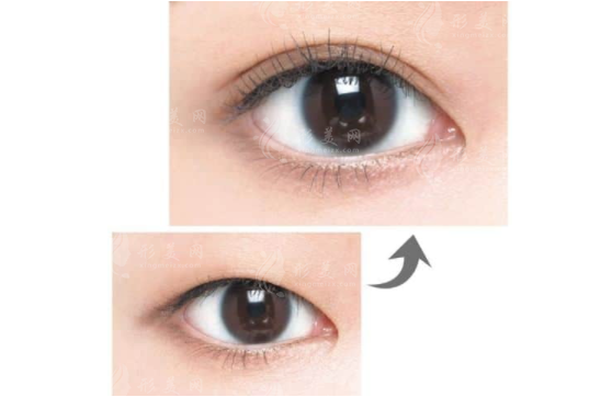 雙眼皮手術(shù)類型有哪些？割雙眼皮術(shù)、點(diǎn)切雙眼皮術(shù)…