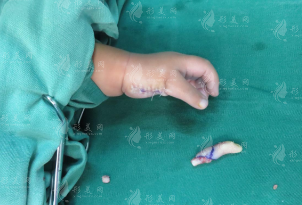 多指切除手術方法有哪些？部分指切除、全指切除、矯正性手術