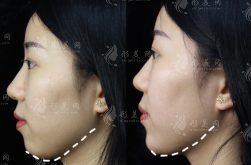 下巴上翹怎么矯正圖片，三種常見方式為你解答