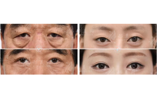 中老年人割眼袋有副作用嗎？割眼袋注意事項(xiàng)解答