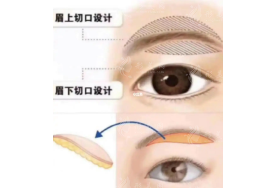 上眼瞼切皮手術(shù)好嗎？多久恢復(fù)自然？科普解答送給你