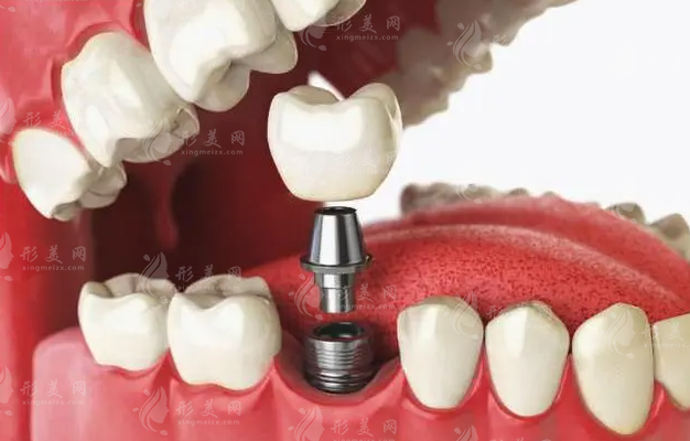 以色列種植牙多少錢(qián)一顆?